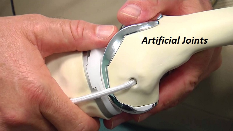Artificial Joints